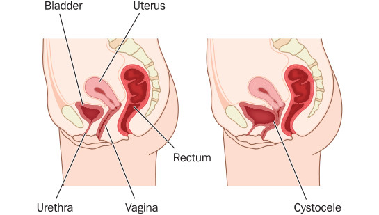 Vaginal Prolapse - Western Michigan Urological Associates