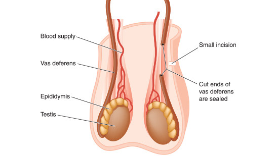 vasectomy procedure